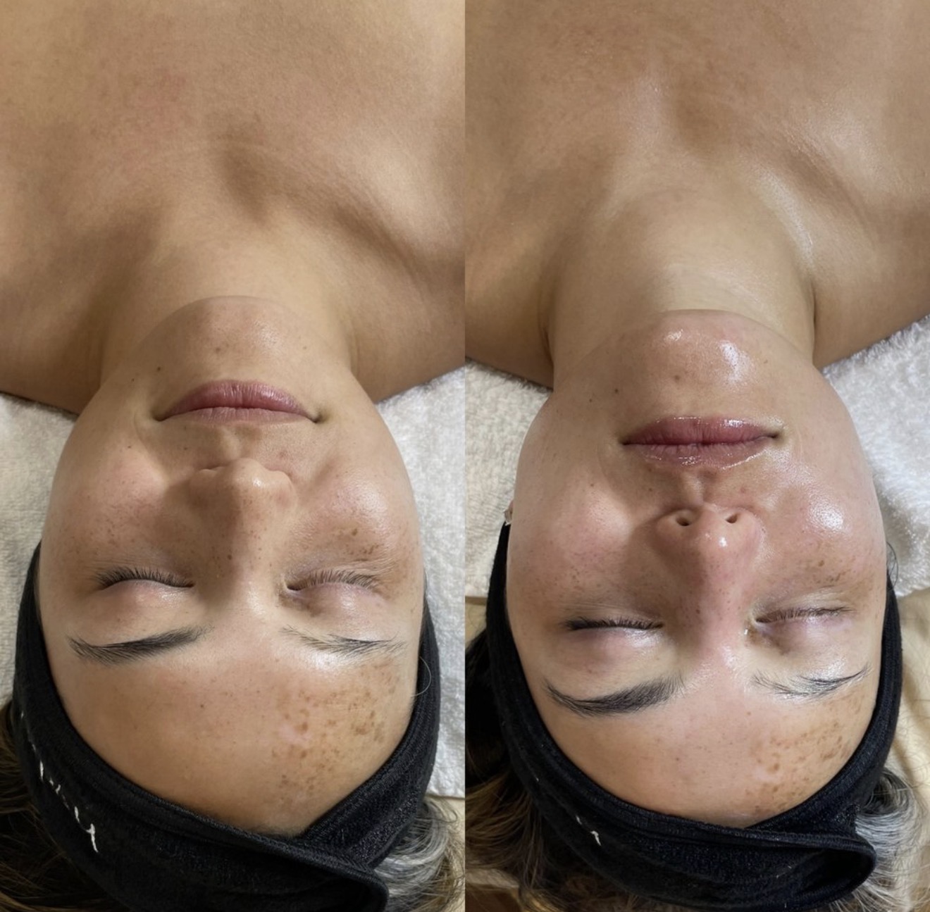 Real client before and after results at K&K Facial Spa