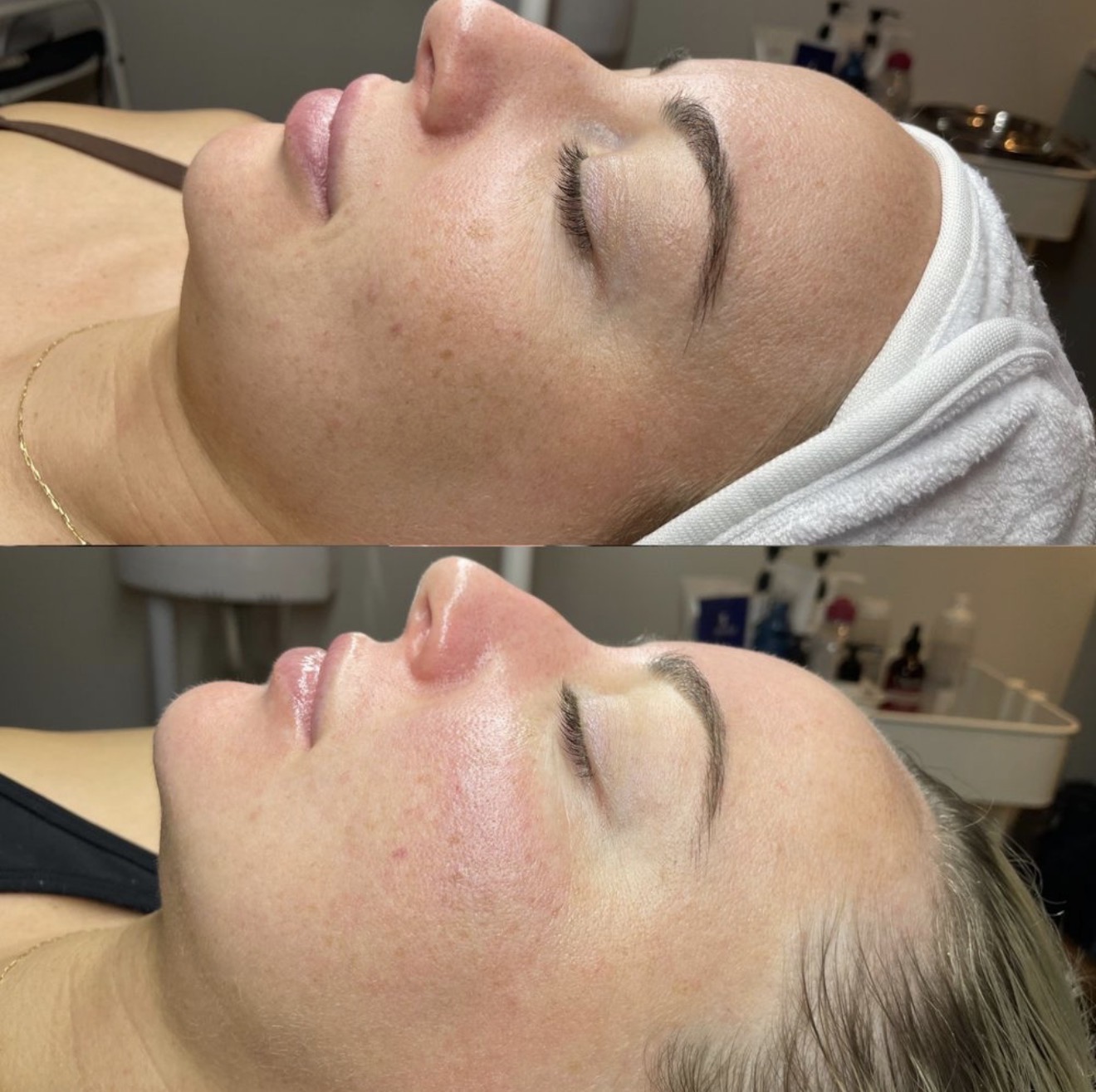 Real client before and after results at K&K Facial Spa