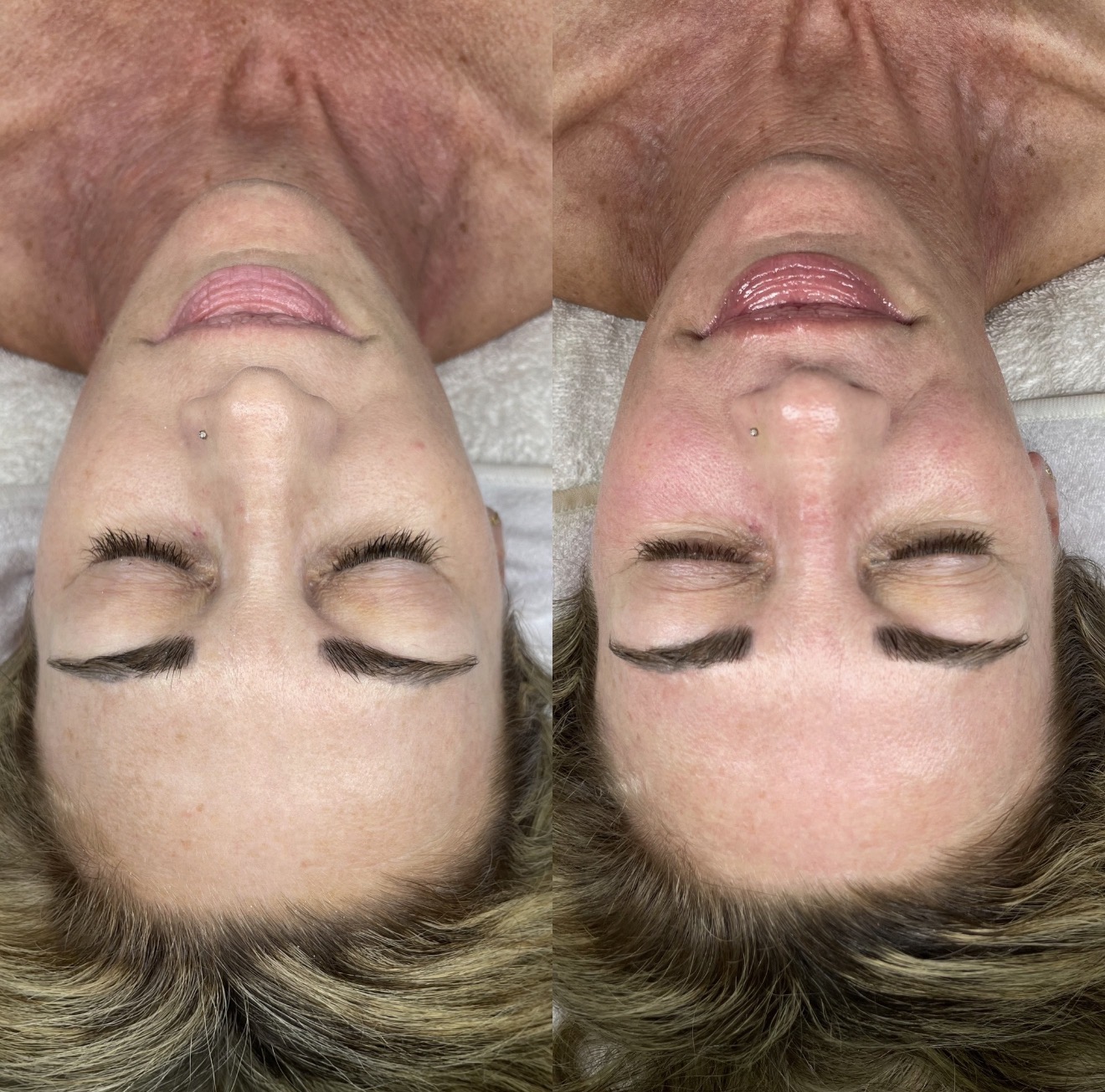 Real client before and after results at K&K Facial Spa