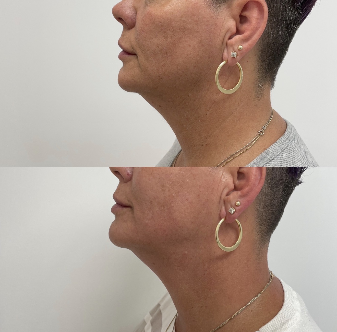 Real client before and after results at K&K Facial Spa