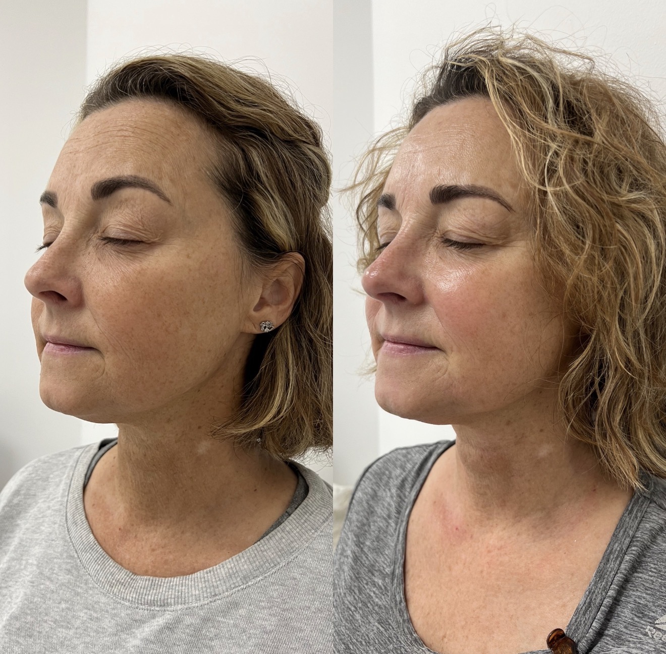 Real client before and after results at K&K Facial Spa
