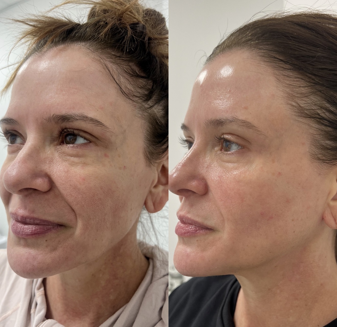 Before and after BioRePeel treatment results at K&K Facial Spa
