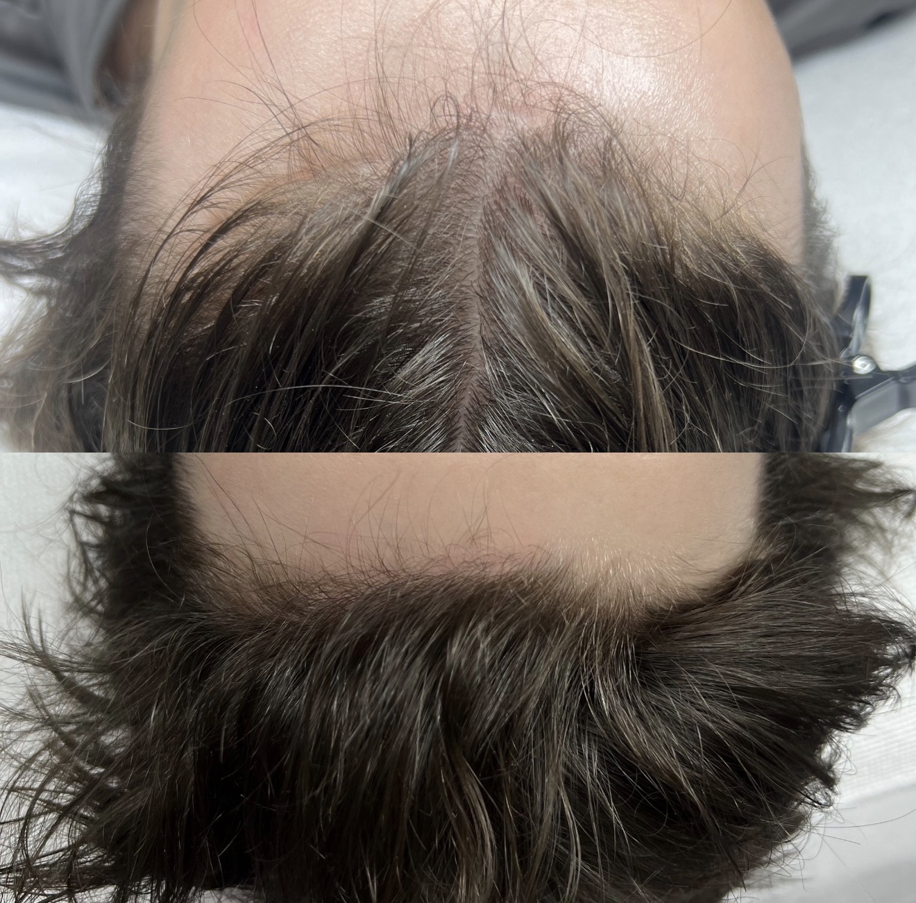 Before and after Keravive scalp treatment results at K&K Facial Spa